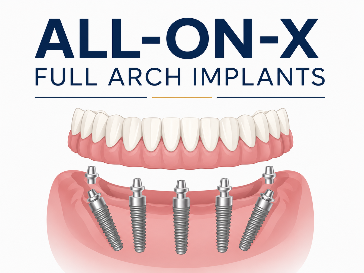 All-on-X Full Arch Implants