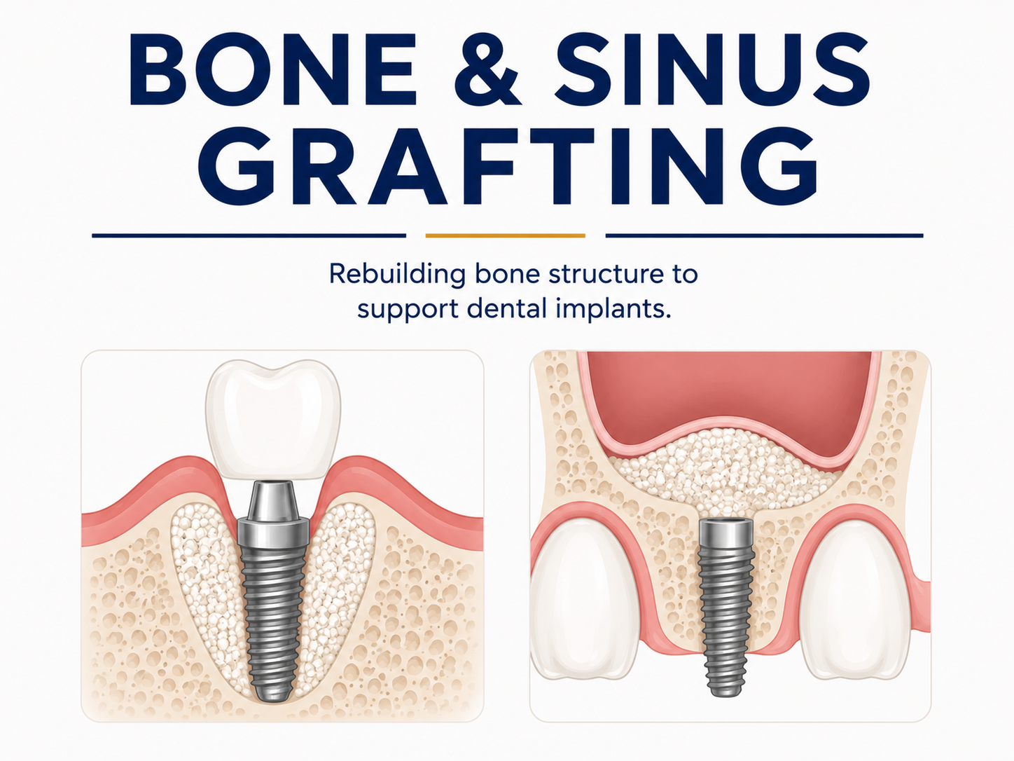 Bone & Sinus Grafting
