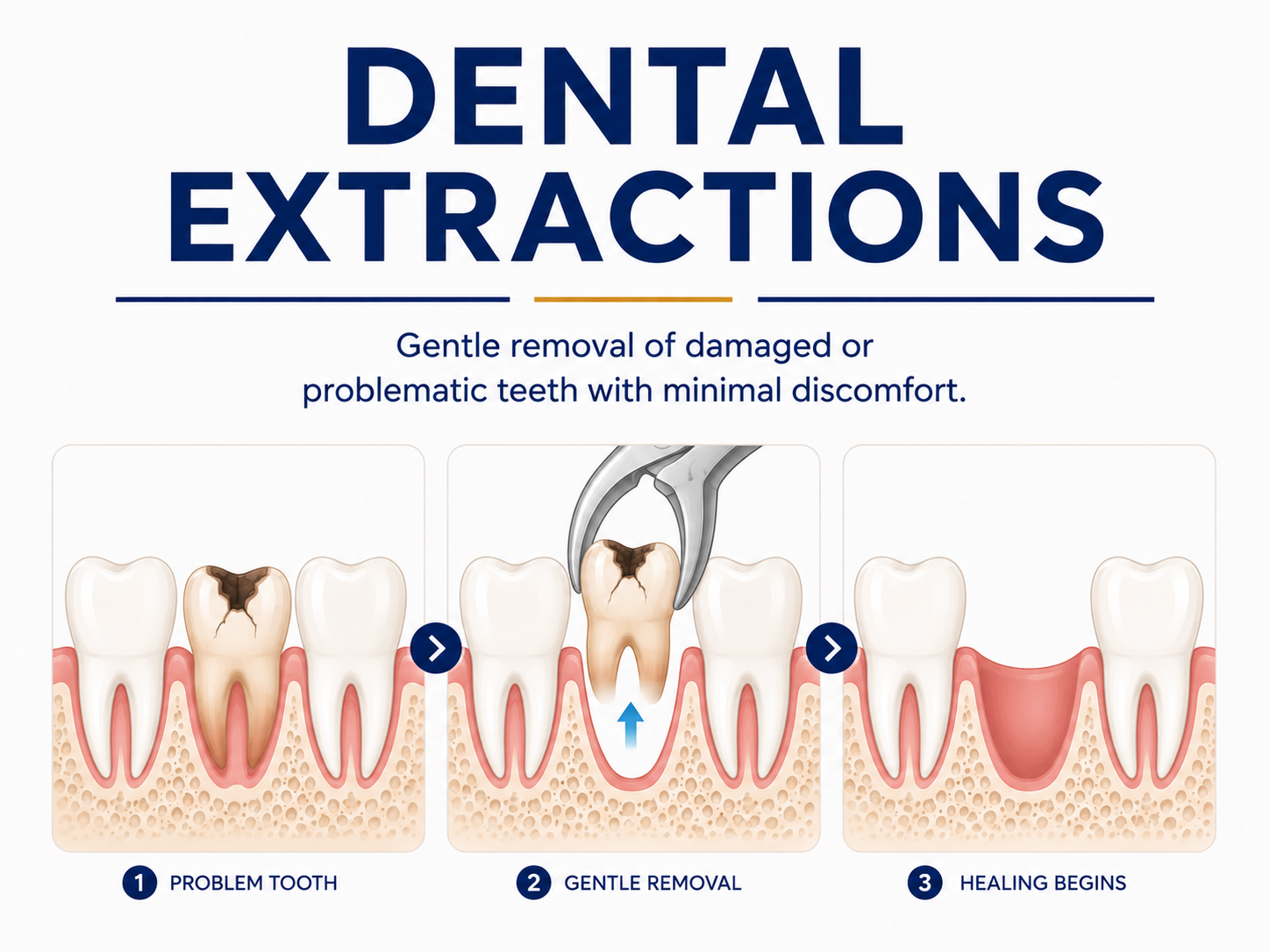 Dental Extractions