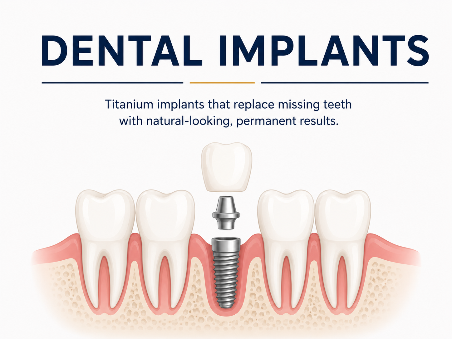 Dental Implants