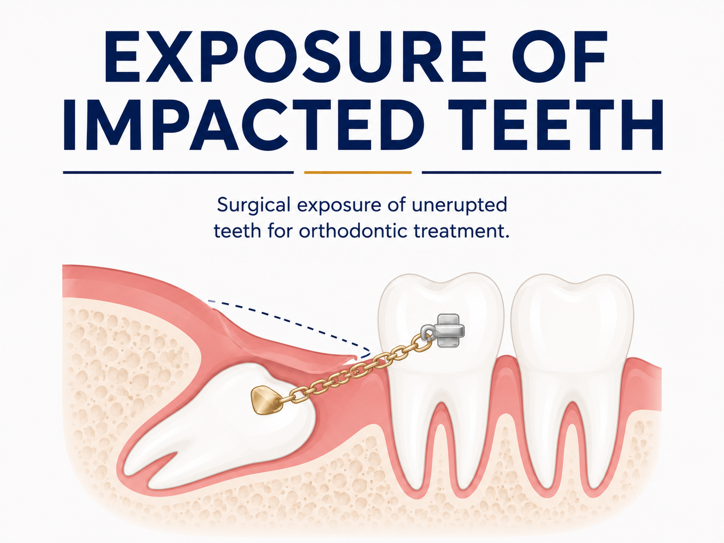 Exposure of Impacted Teeth