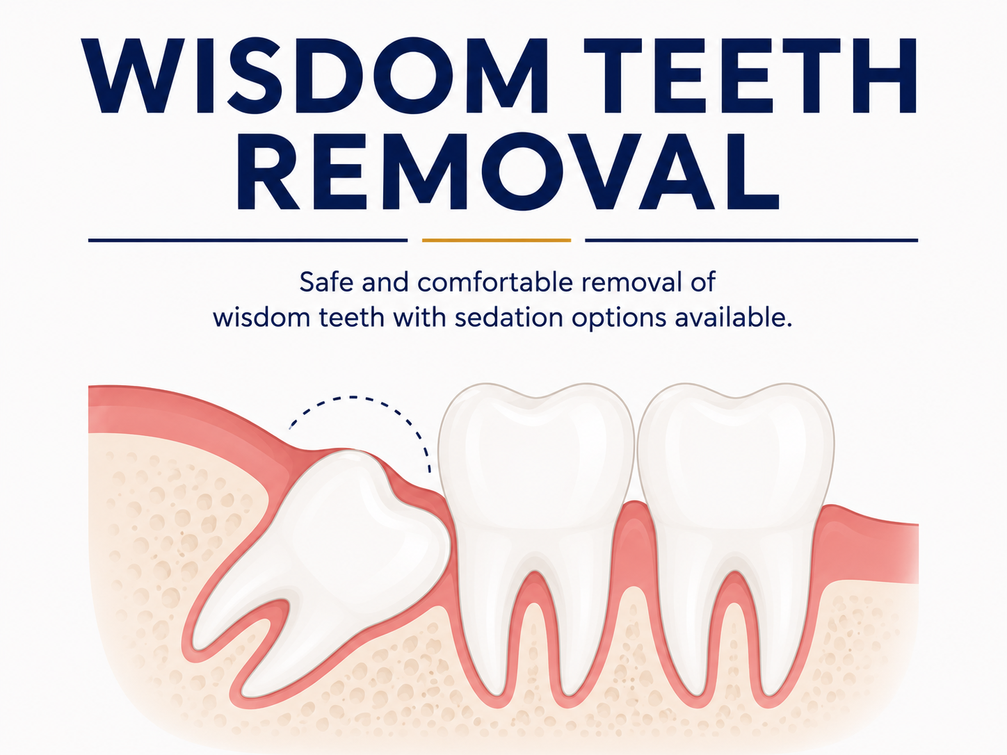 Wisdom Teeth Removal